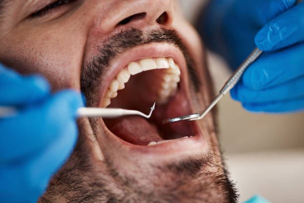 Best Emergency Dental Care for Broken or Chipped Teeth in Signal Hill, CA