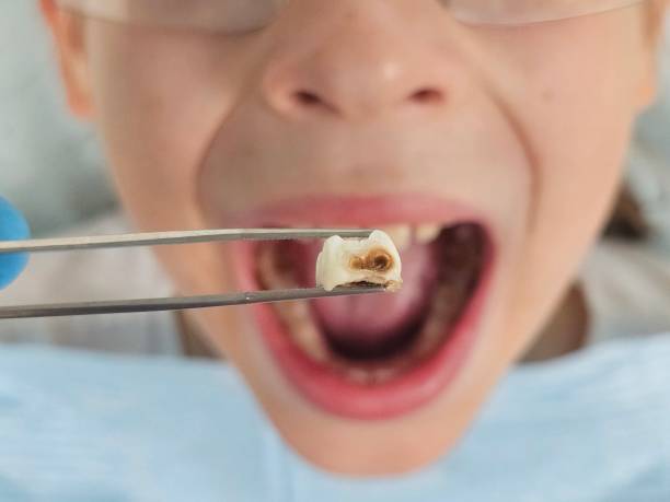 Best Emergency Gum Treatment in Signal Hill, CA